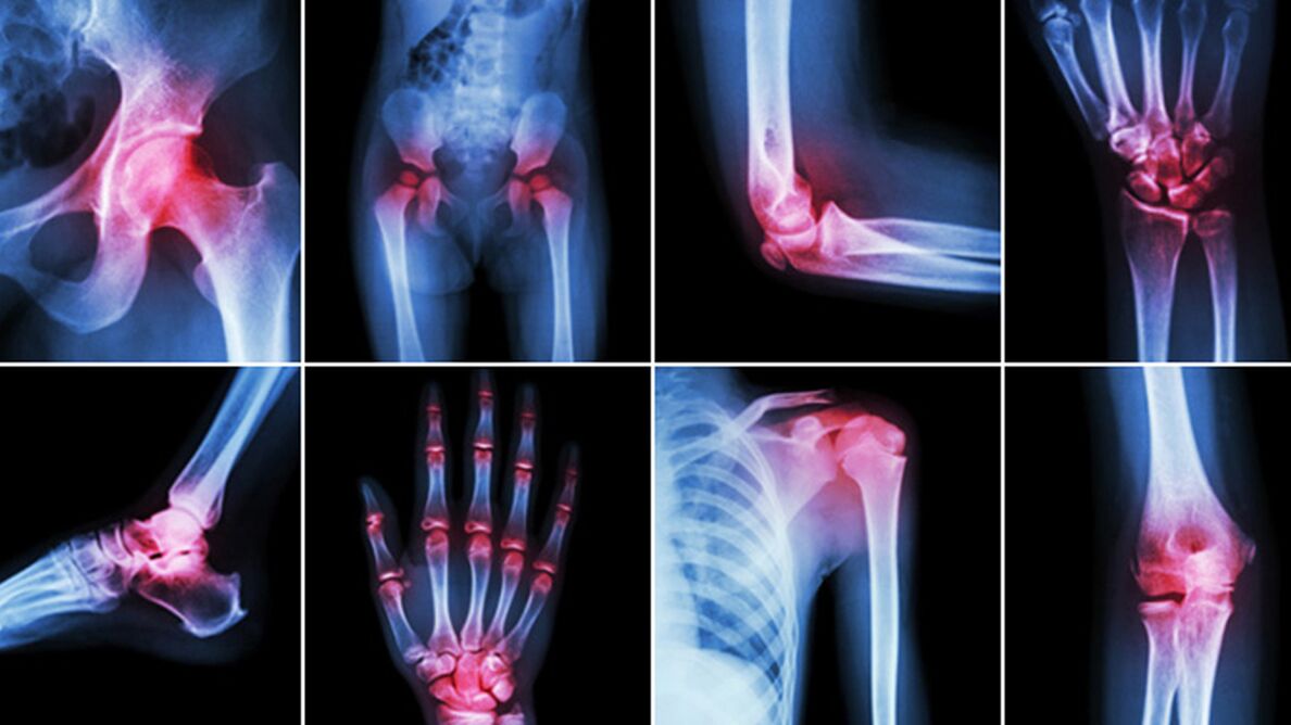 Рентген за болове у зглобовима