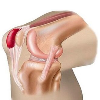 Један од узрока болова у коленском зглобу је бурзитис. 