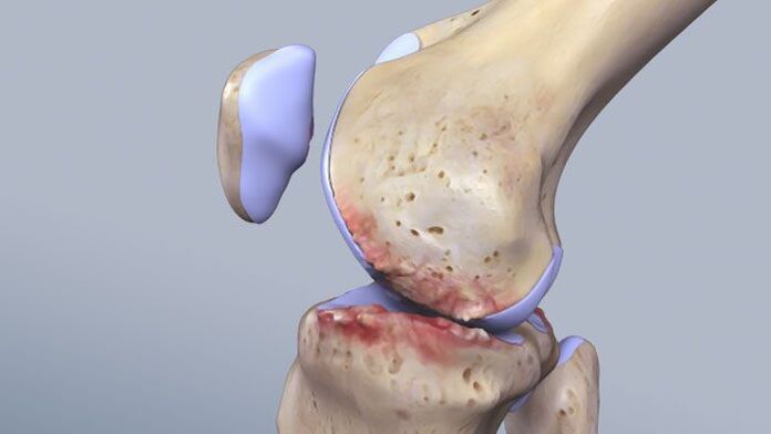 Структура коленског зглоба погођена патологијом