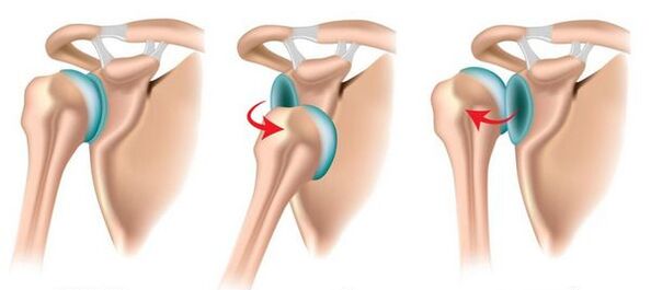 Предња и задња дислокација раменог зглоба, изазивајући развој артрозе