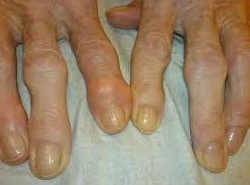 Остеоартритис малих зглобова шака руке